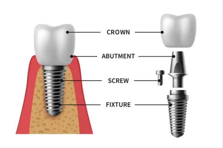 dental implant explainer