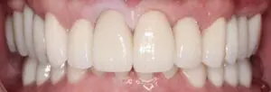Pt 1 After (Full Mouth Rehabilitation)
