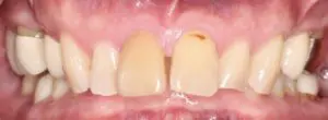 Pt 1 Before (Full Mouth Rehabilitation)