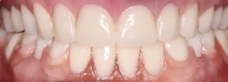 Pt 10 After Removable Prothodontics