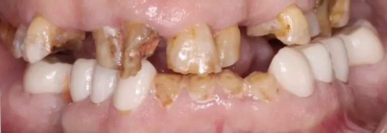 Pt 10 Before Removable Prosthodontics