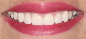 Pt 2 After (Veneers)