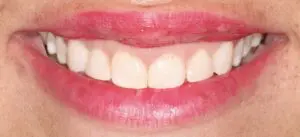Pt 2 Before (Veneers)