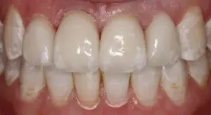 Pt 3 After (Veneers)