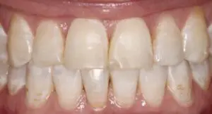 Pt 3 Before (Veneers)