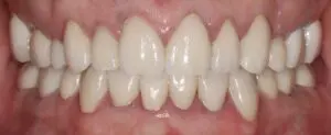 Pt 4 After (Full Mouth Rehabilitation) front