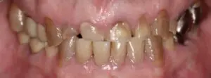 Pt 4 Before (Full Mouth Rehabilitation) front