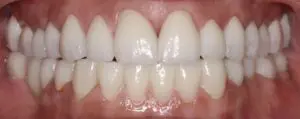 Pt 5 After (Full Mouth Rehabilitation) teeth