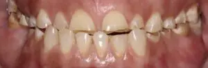Pt 5 Before (Full Mouth Rehabilitation) teeth