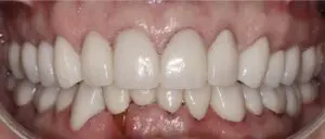 Pt 6 after (Full Mouth Rehabilitation)
