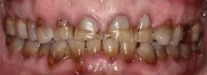 Pt 6 Before (Full Mouth Rehabilitation)