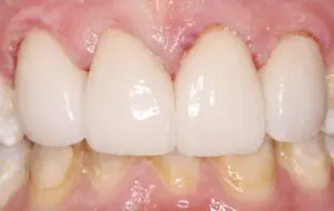 Pt 7 After (Veneers)-teeth