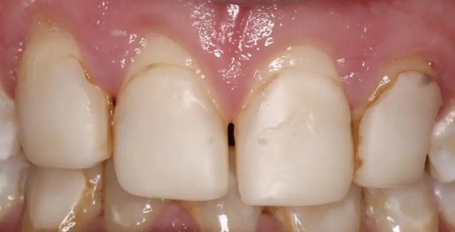 Pt 7 Before (Veneers)-teeth