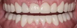 Pt 8 After (Full Mouth Rehabilitation)