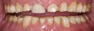 Pt 8 Before (Full Mouth Rehabilitation)