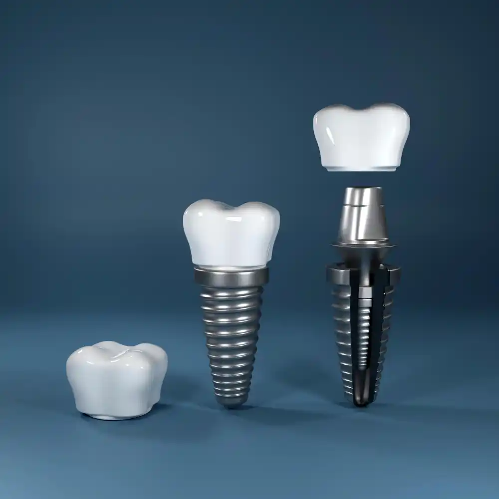 Dental implant model