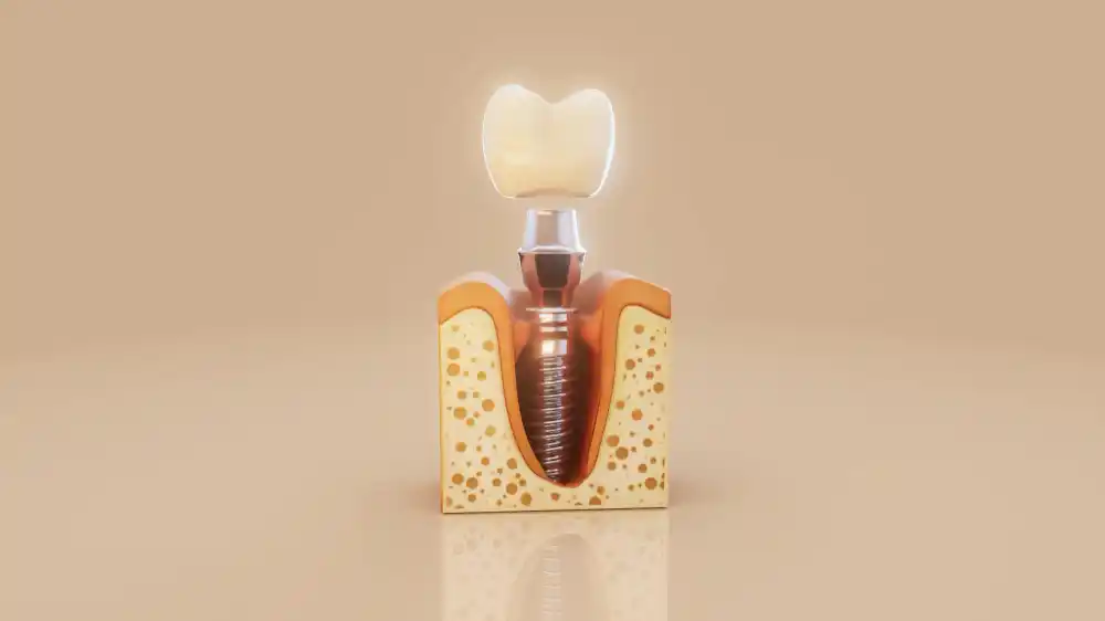 Dental implant model