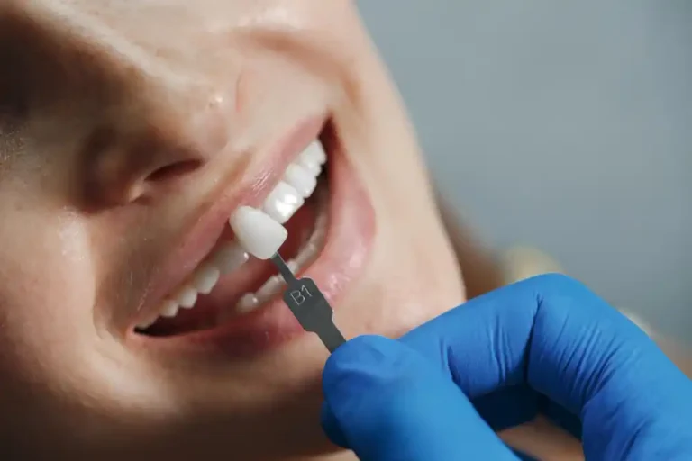 Veneer example