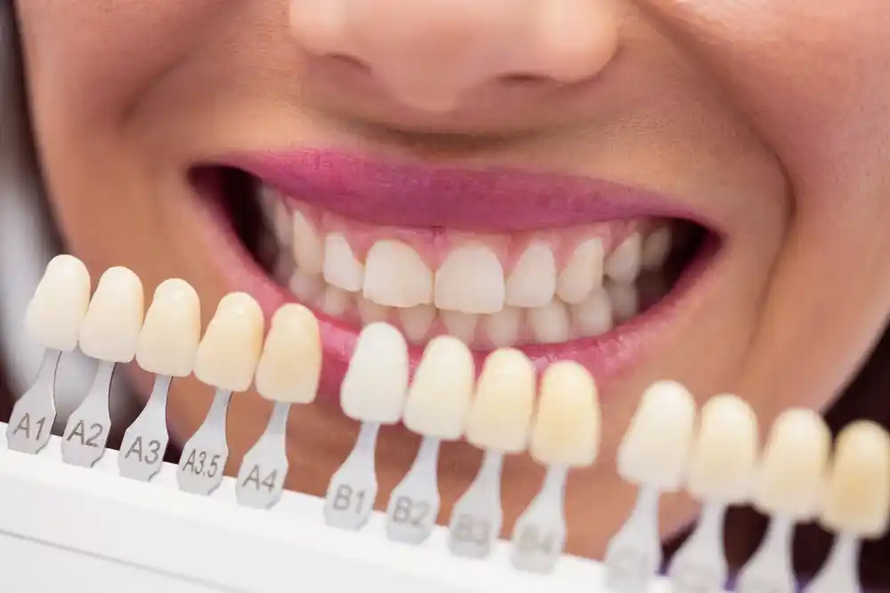 Dental veneers selection