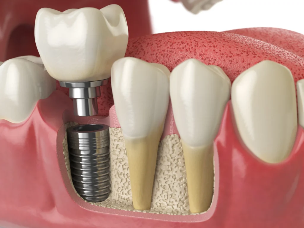 Dental implant model