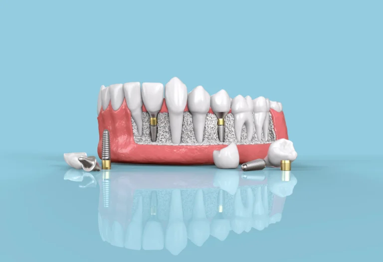 Dental implant model