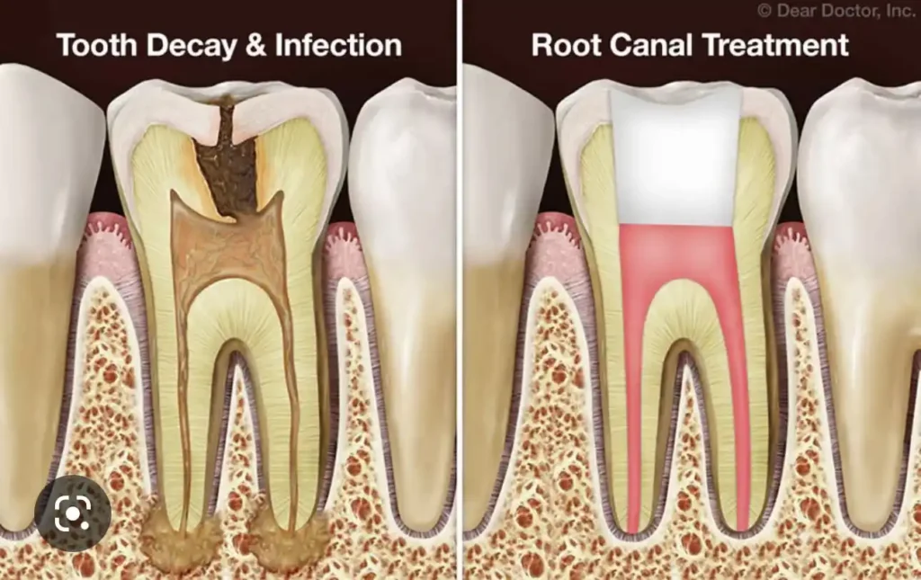 Root canal explainer